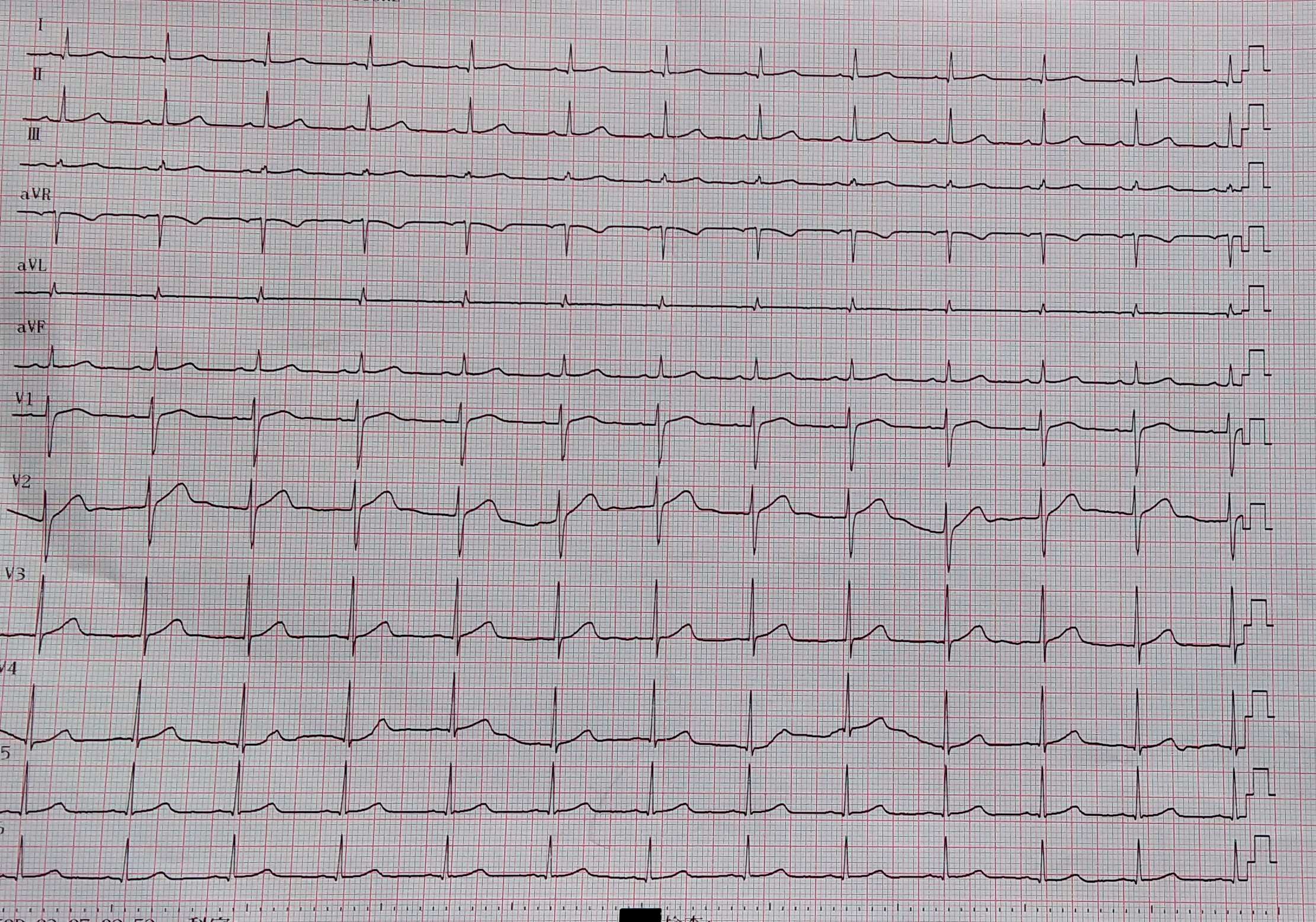41 岁小伙险些丧命，广西壮族自治区南溪山医院医护力挽狂澜