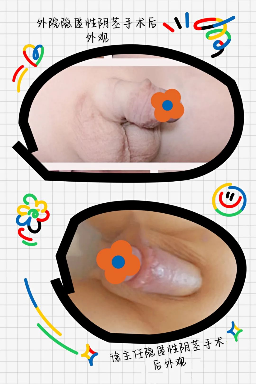 我的孩子出生时,小丁丁只有花生米大小