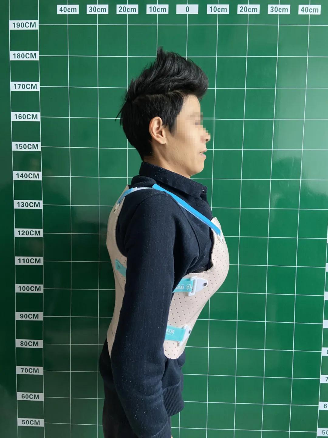杭州市萧山区中医院再次成功挑战脊柱畸形高难度手术