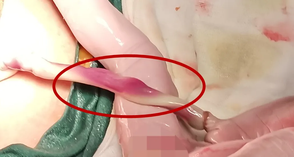 贵州从江一胎儿突发危象命悬一线，帮扶医生果断抉择救下宝宝