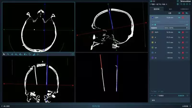 精准高效治疗帕金森：广西医科大学第一附属医院成功开展首例机器人辅助脑深部电刺激（DBS）手术