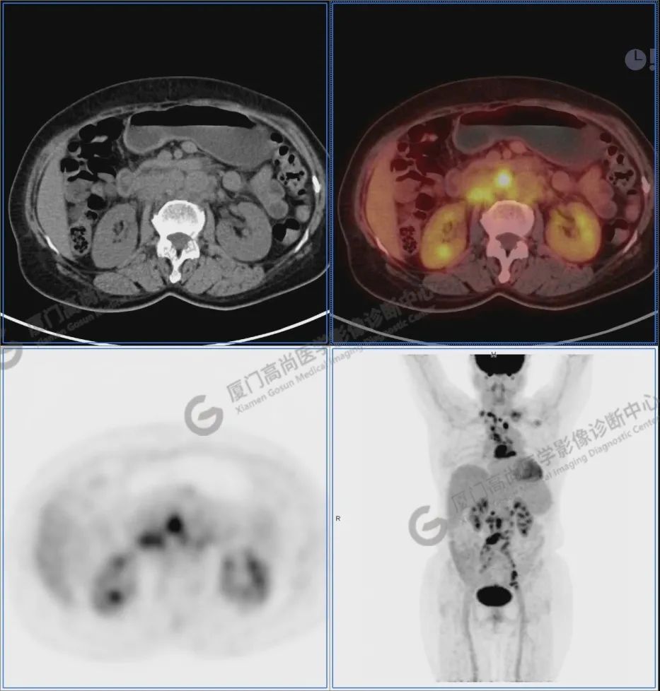 高尚病例：发现颈部转移瘤，如何诊断和定位原肿瘤？