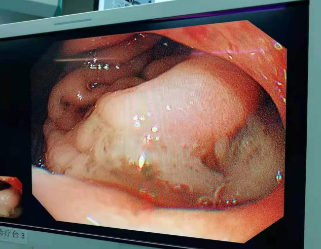 大型胃镜设备缘何「移驾」ICU?——记一例急诊胃镜