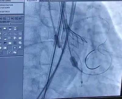 合肥京东方医院首例 TAVR 手术成功,心脏主动脉瓣置换现已进入「介入换新」时代