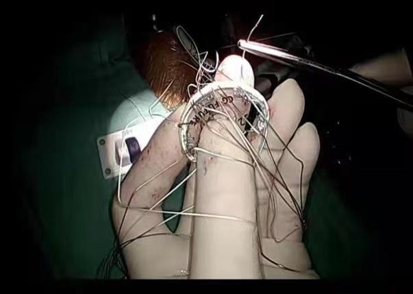 西安交通大学第一附属医院不开胸去「心病」,「拆弹专家」再续传奇