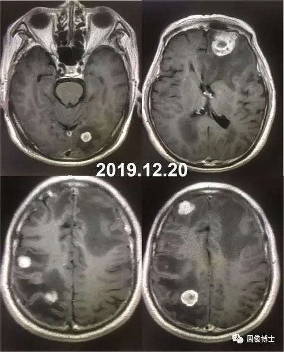 周俊主任：肺癌脑转移又发癫痫，75 岁老者如何闯过难关？