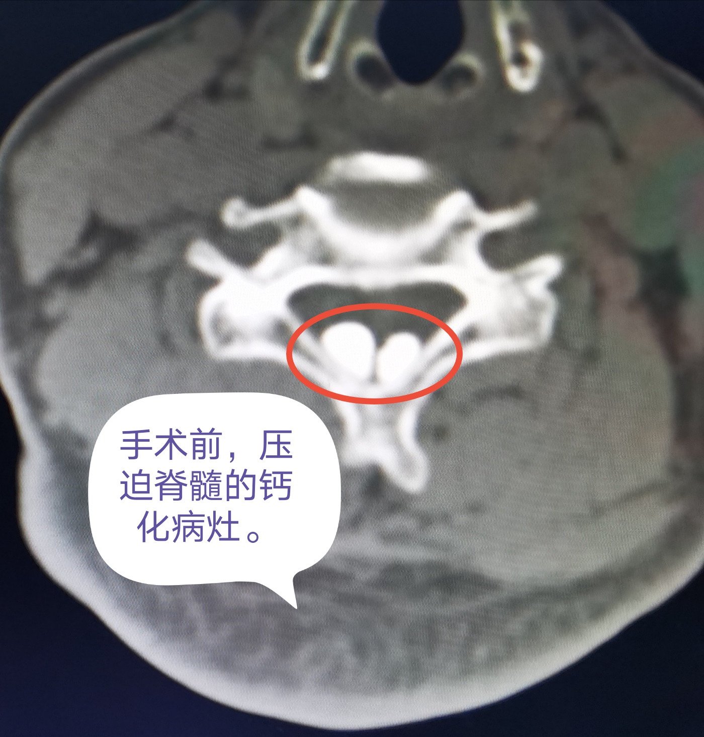 广西首例椎间孔镜下颈椎椎板切除加黄韧带钙化摘除手术在自治区南溪山医院顺利完成