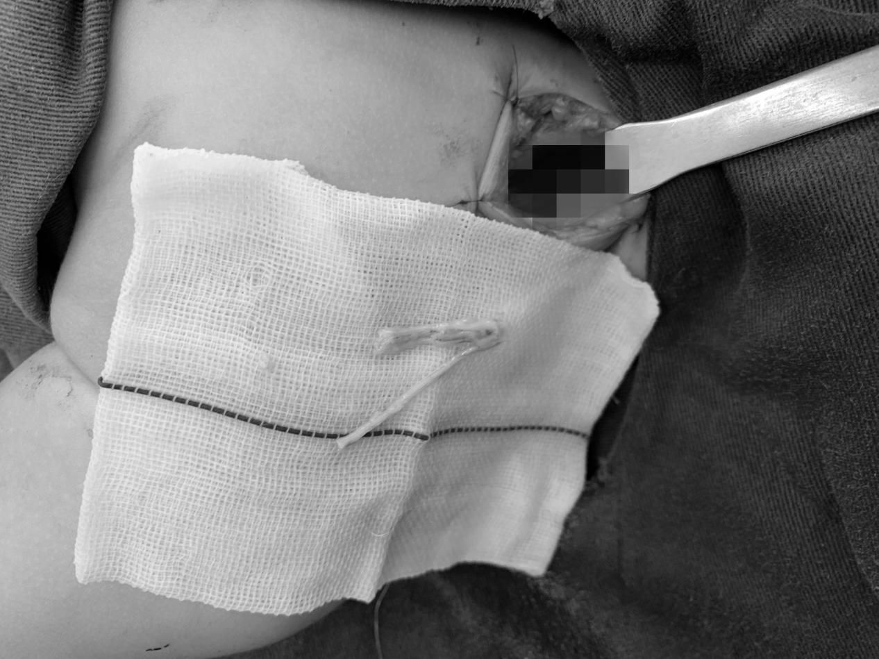 南大二附院整形美容科完成一例 3 月龄新生儿分娩性臂丛神经移植修复术