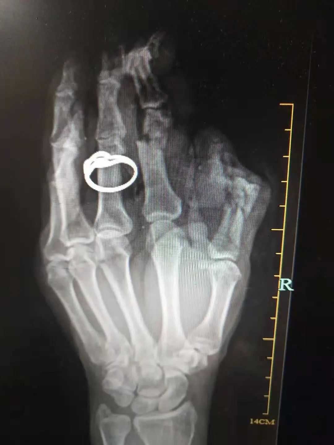 「移花接木」拇指再造，上海海华医院成功完成一例复杂拇指再造术