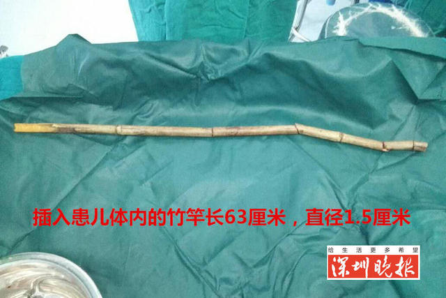 竹棍从10岁男童大腿根部插入贯穿心脏