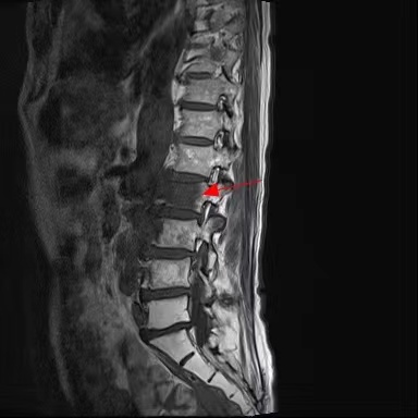 肿瘤转移到脊柱 = 没得治？杭州市萧山区中医院挺进骨科手术「雷区」，成功切除肿瘤