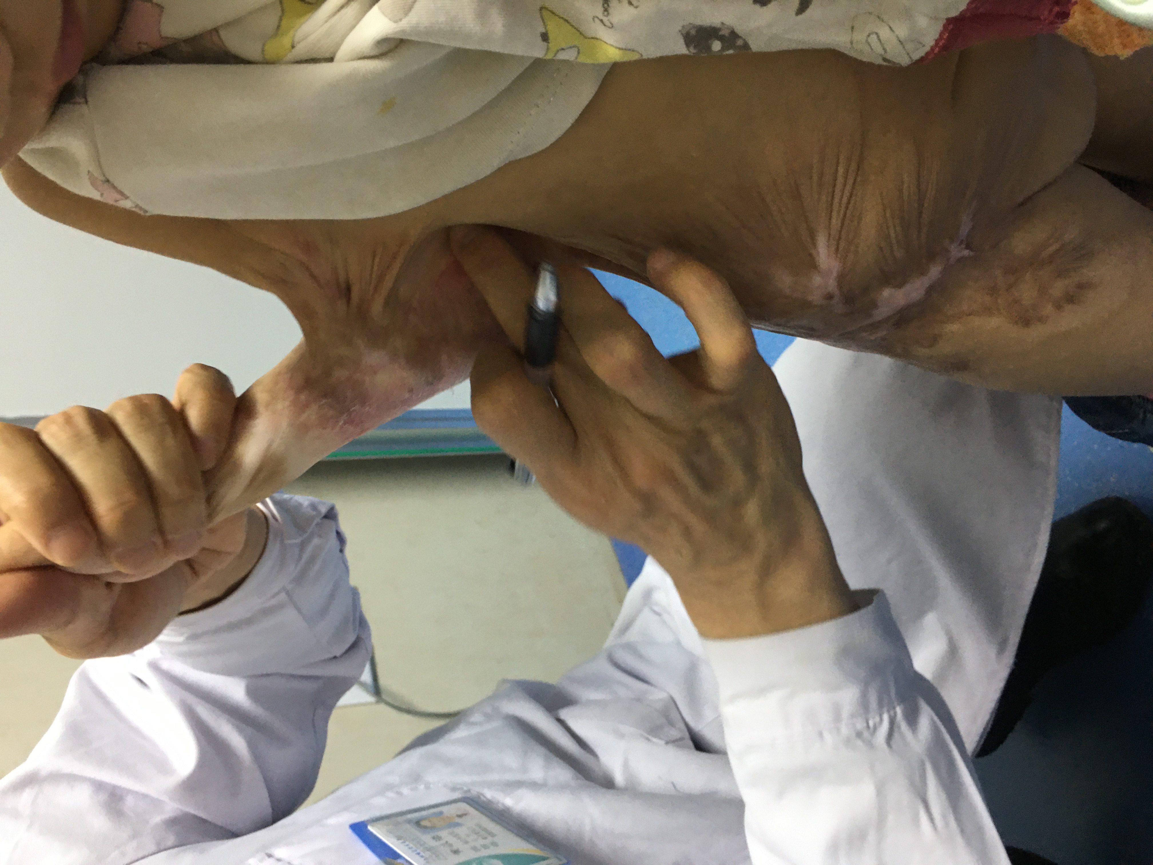 4 岁女童重度烫伤险致残疾，医生巧妙分离「鸭蹼」手臂
