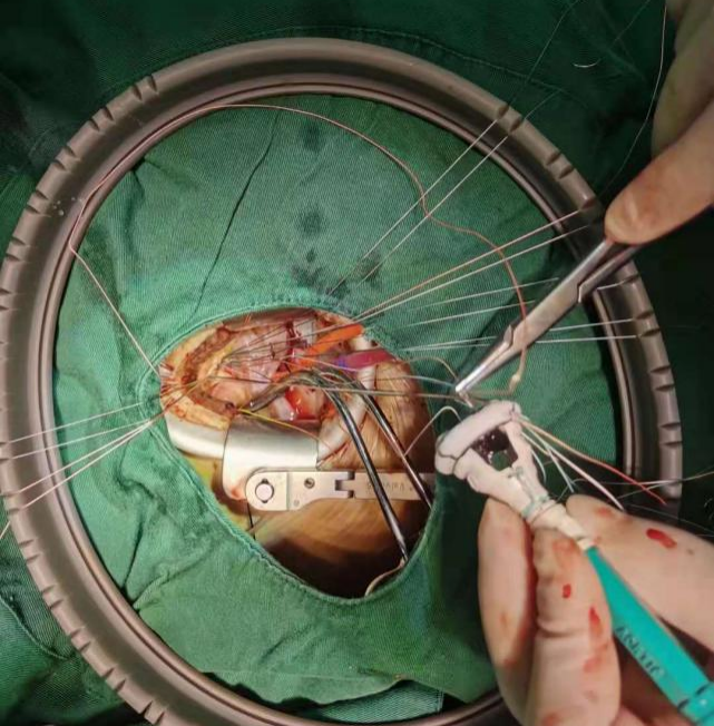 南昌大学第二附属医院心脏大血管外科为熊猫血患者完成微创胸腔镜下主动脉瓣置换术