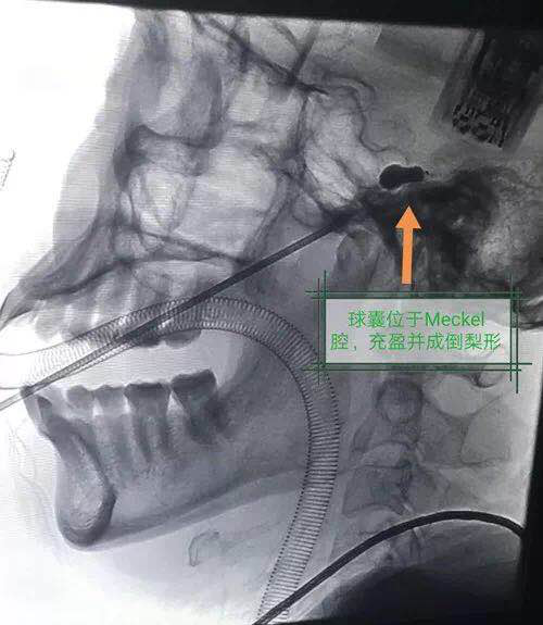 「天下第一痛」患者千里寻医，只为找到他…..