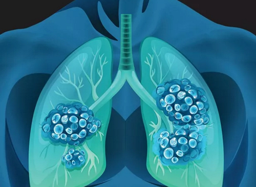 创新靶向药阿来替尼登陆中国！让肺癌变成慢性病成为可能！
