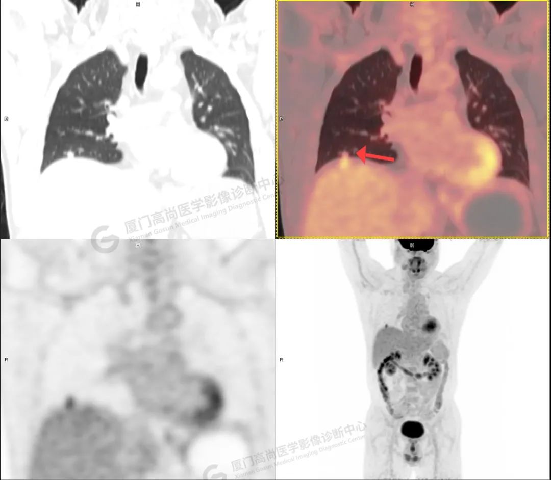 高尚病例：胸部 CT 检查在肺癌早筛中的应用