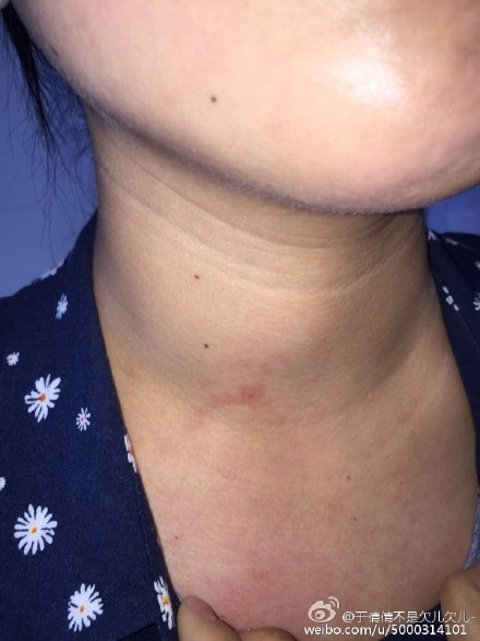 中秋节女护士被殴打 凶手叫嚣让女护士脱裤子尿尿