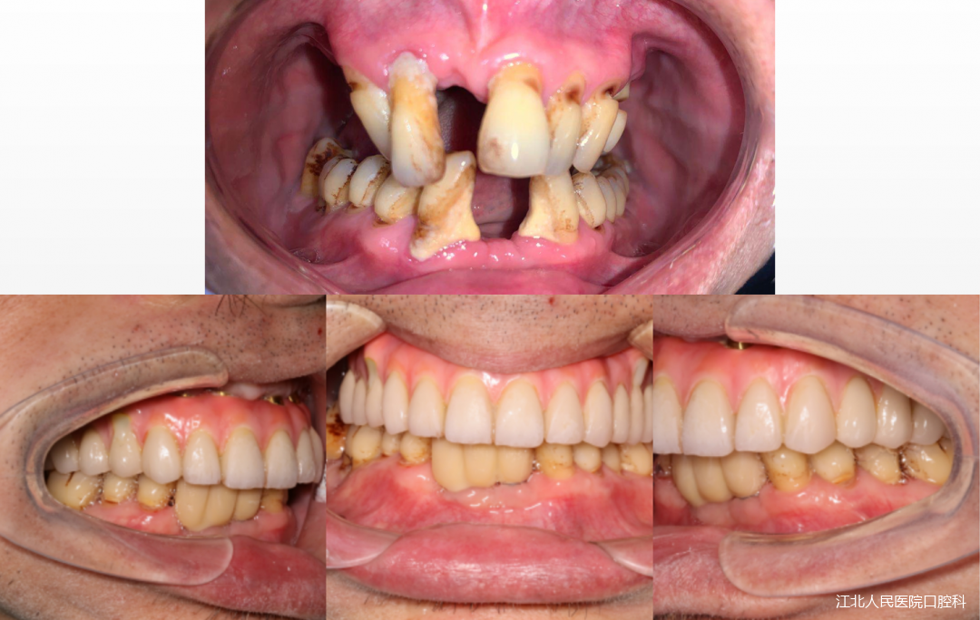 南京江北医院口腔科助力患者重拾笑容和年轻