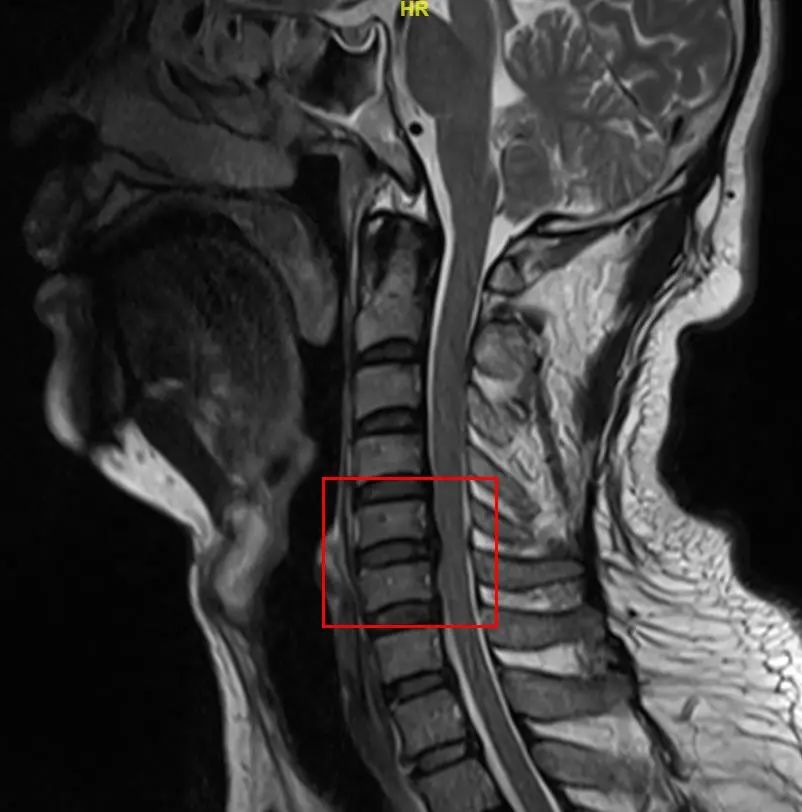 「微创+精准」——苏州明基医院成功为一位脊髓中央损伤综合症患者手术