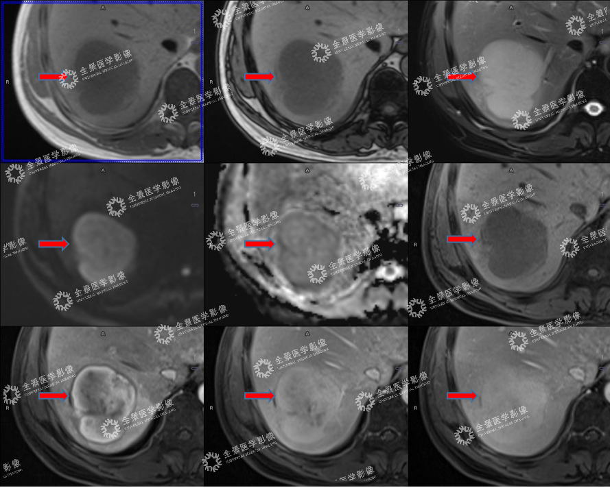 肝内占位性病变 | 2 次检查无果，PET/CT-MR 提供诊断治疗依据