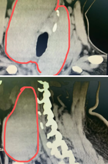 喘不过气！张姐被脖子上的俩大「腰子」扼住了喉咙