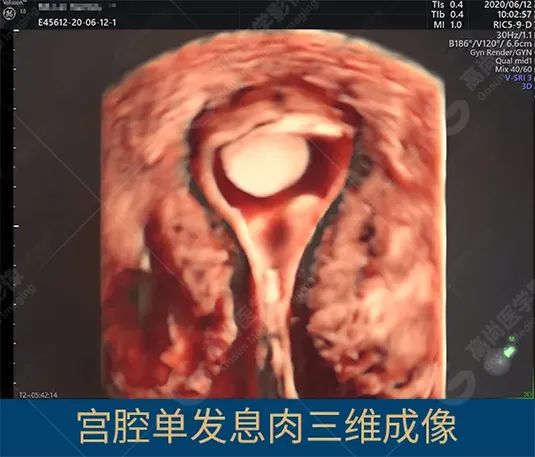 高尚超声：四维/三维子宫输卵管超声造影