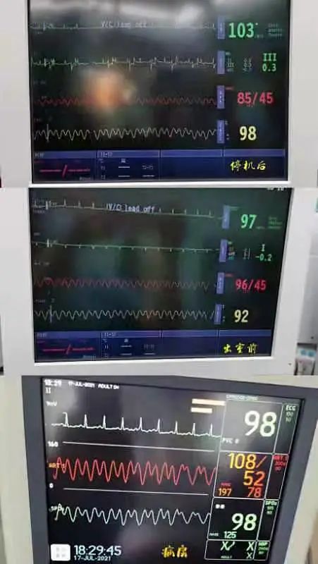 延安大学附属医院成功实施主动脉球囊反搏下冠状动脉旁路移植术