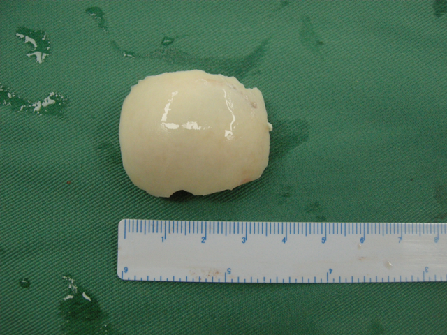 天津市第一中心医院创新性开展股骨头坏死新鲜原位软骨移植联合吻合血管腓骨移植术