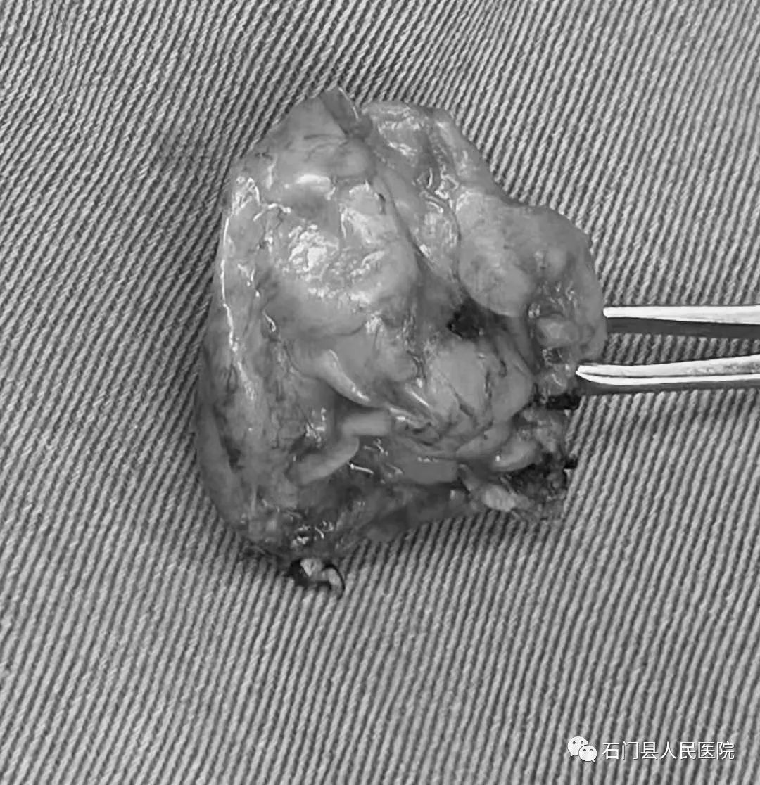 突破！石门县人民医院耳鼻喉科完成首例经口入路侧颅底肿瘤切除！