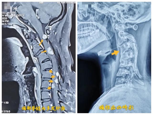 26岁，颈椎一共7节，颈部脊髓却发现8个肿瘤……