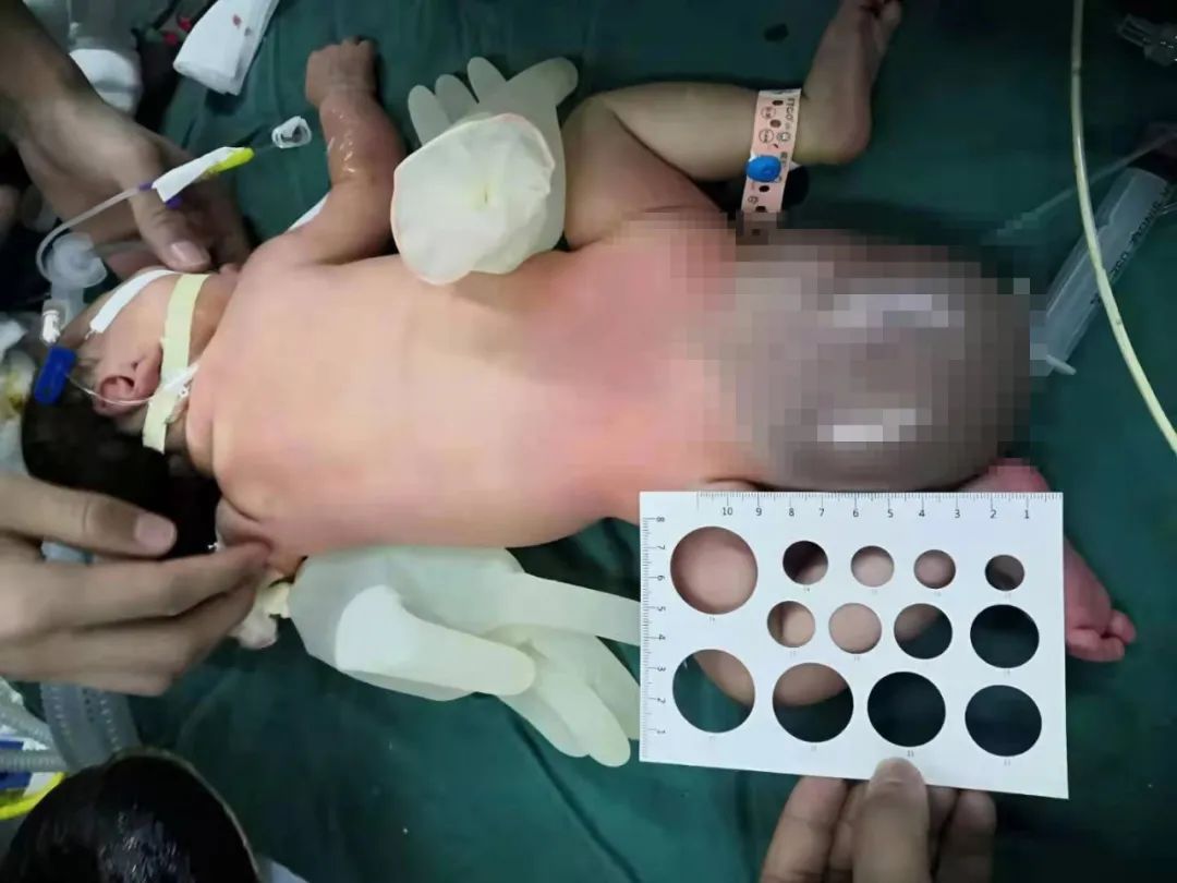江西省儿童医院成功为刚出生女婴切除巨大畸胎瘤
