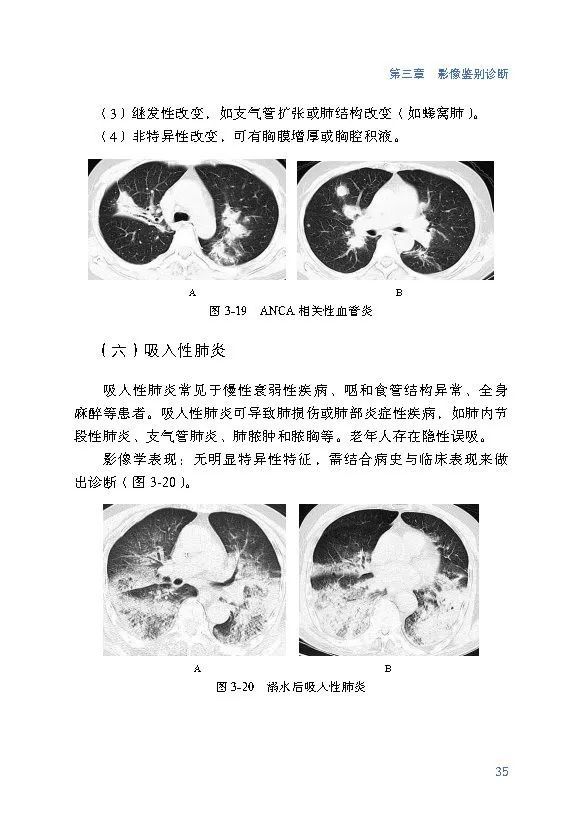 浙江省《新冠肺炎 CT 早期征象与鉴别诊断》出版并免费共享
