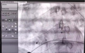 深圳市首例!龙岗区人民医院为房颤、房缺患者消除「隐形炸弹」!
