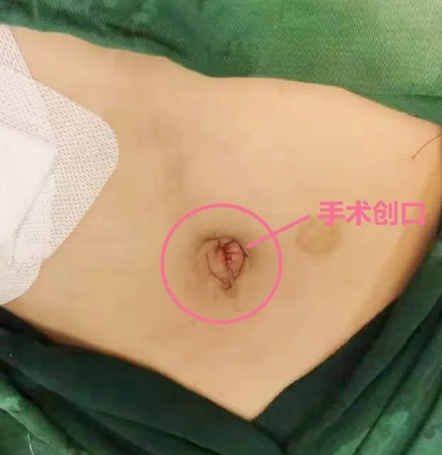 震惊！医生从她的肚子里掏出长达 1.6 米的子宫肌瘤