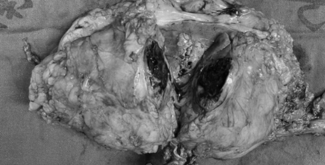 南昌大学第二附属医院泌尿外科刘飞教授团队成功完成一例腹腔镜左肾癌根治性切除并癌栓取出术