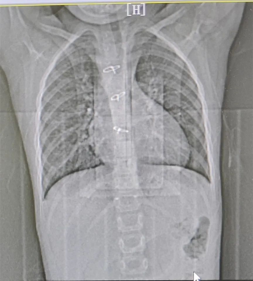 6 岁先心病女孩的获救 | 所有美好结果都起源于【不愿放弃】的期望