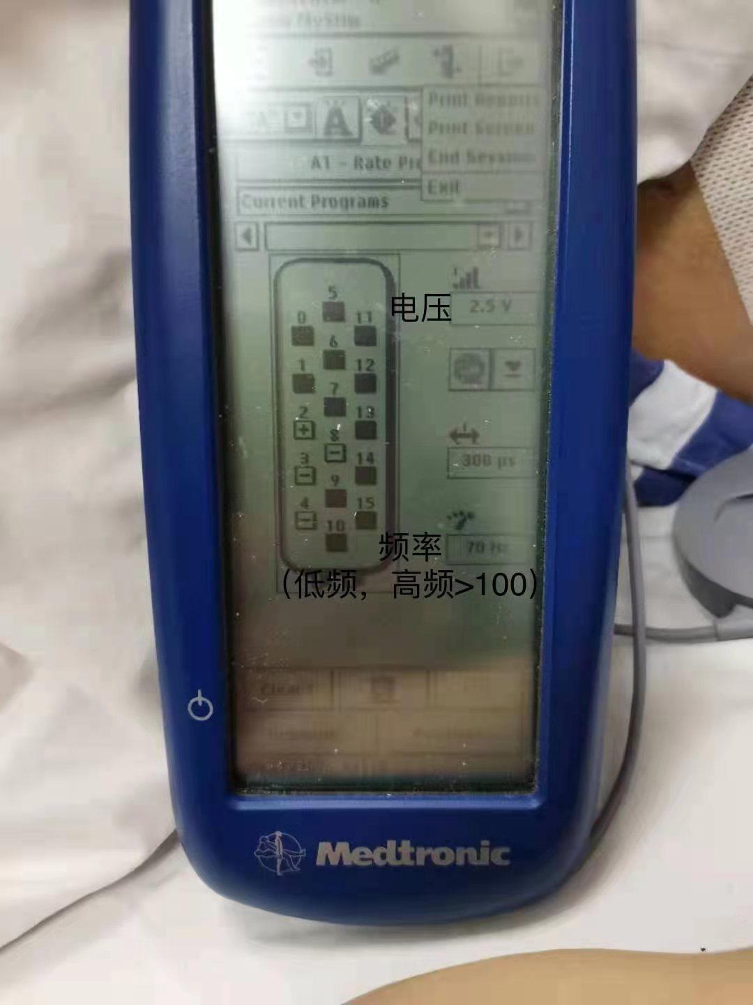 深受罕见疼痛折磨，常州市第二人民医院新技术为患者带来希望