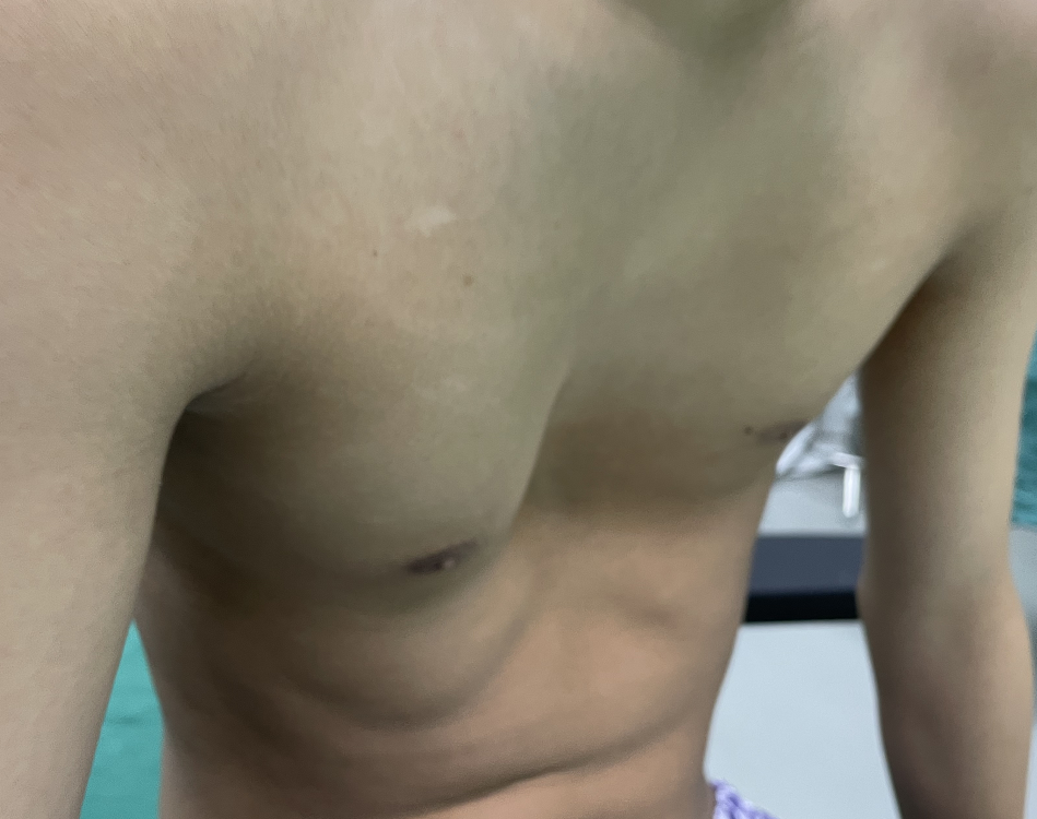 苏州明基医院：孩子胸部凹陷，并不是缺钙，可能是胸廓畸形！