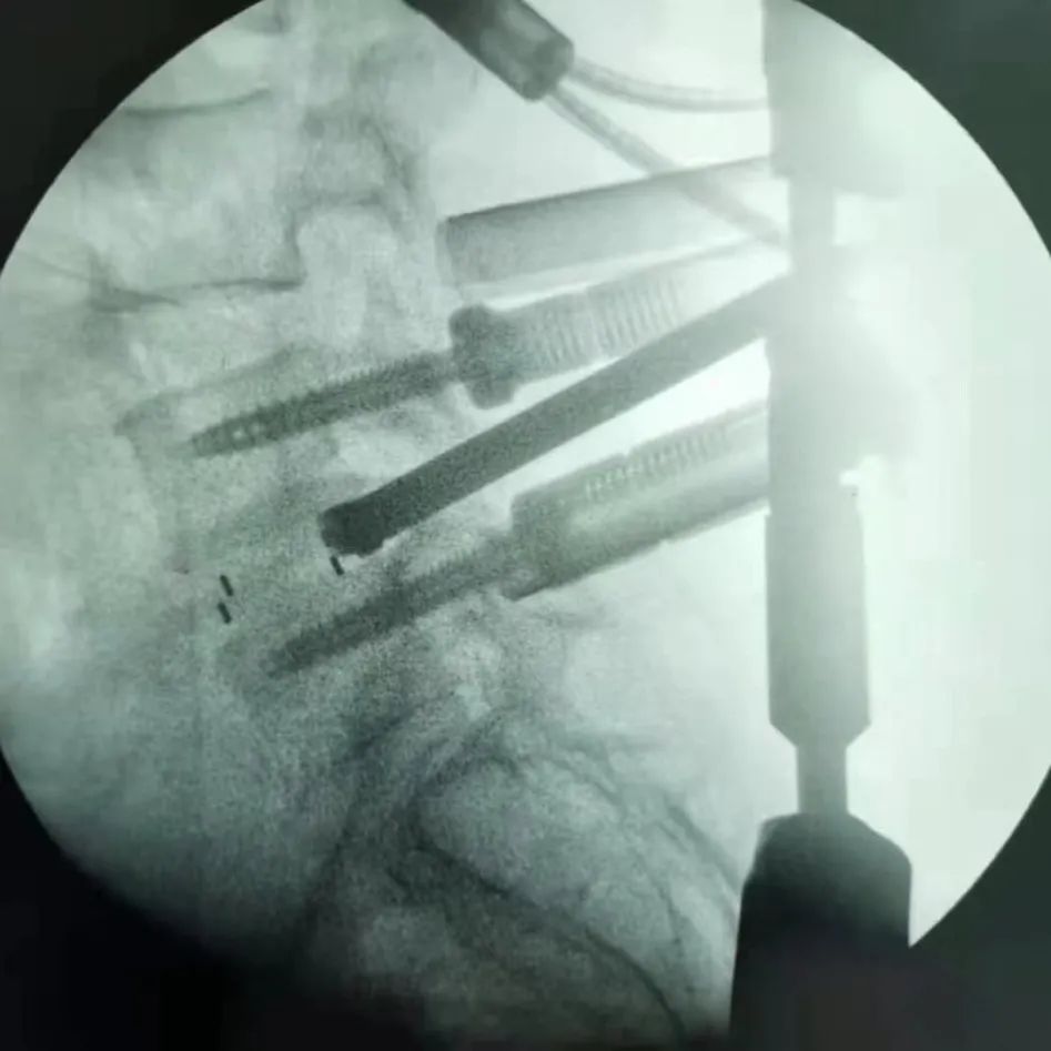 脊柱外科运用微创（MIS-TLIF）技术解除患者腰椎疼痛