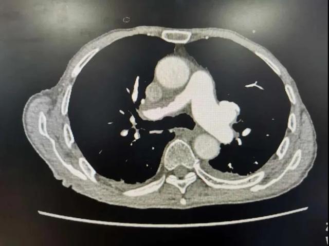 突发肺栓塞命悬一线，西安大兴医院急诊介入「力挽狂澜」