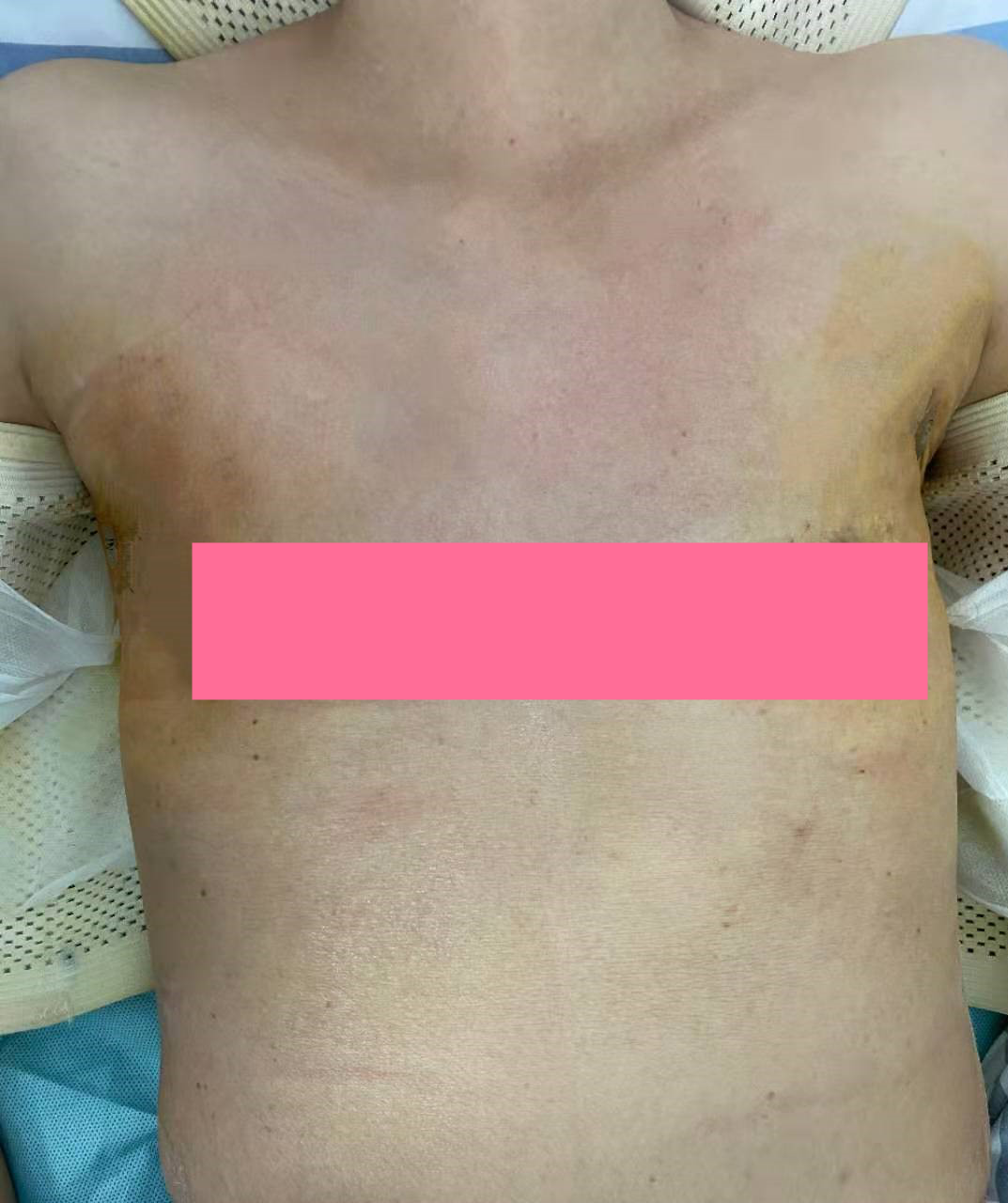 南溪山医院成功实施首例无充气经腋窝入路全乳腺切除手术
