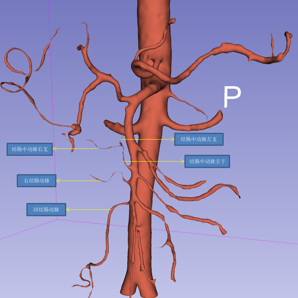 同济大学附属同济医院普通外科完成 3D 腹腔镜三孔尾侧入路联合中间翻页式清扫右半结肠癌根治术