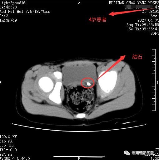 淮南朝阳医院：泌尿系结石小课堂之输尿管结石