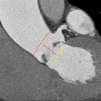 合肥京东方医院首例 TAVR 手术成功,心脏主动脉瓣置换现已进入「介入换新」时代