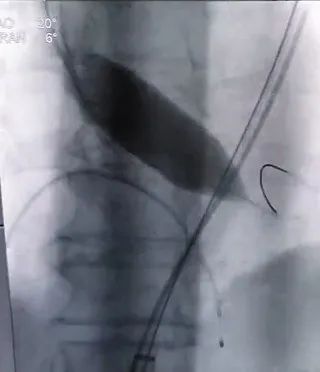 合肥京东方医院首例 TAVR 手术成功,心脏主动脉瓣置换现已进入「介入换新」时代