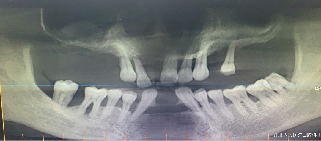 南京江北医院口腔科助力患者重拾笑容和年轻