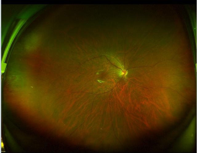 杭州爱尔「争分夺秒」24 小时内完成孔源性视网膜脱离手术救治
