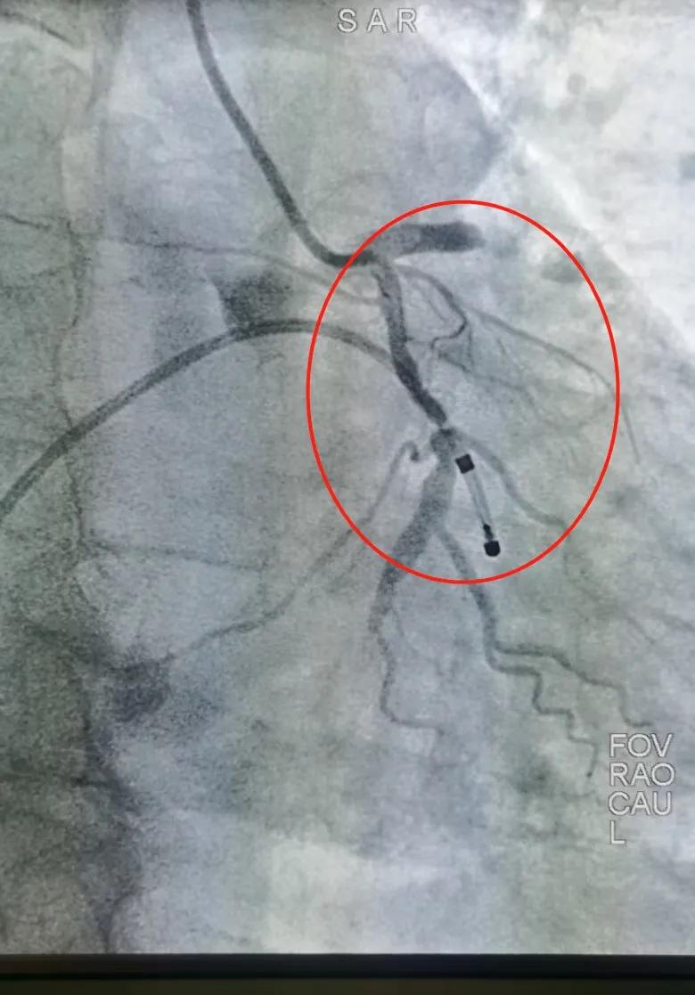 ECMO 加持下的心梗「生死时速」