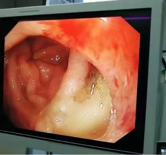 大型胃镜设备缘何「移驾」ICU?——记一例急诊胃镜