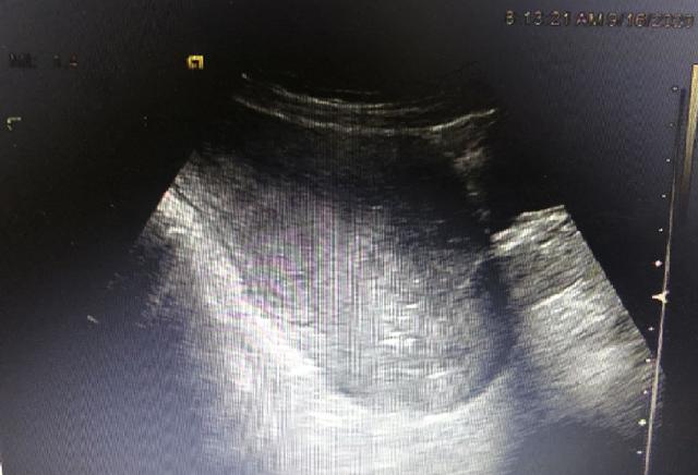 怀孕 6 个月遇上完全性植入胎盘  西安高新医院完成「保宫行动」
